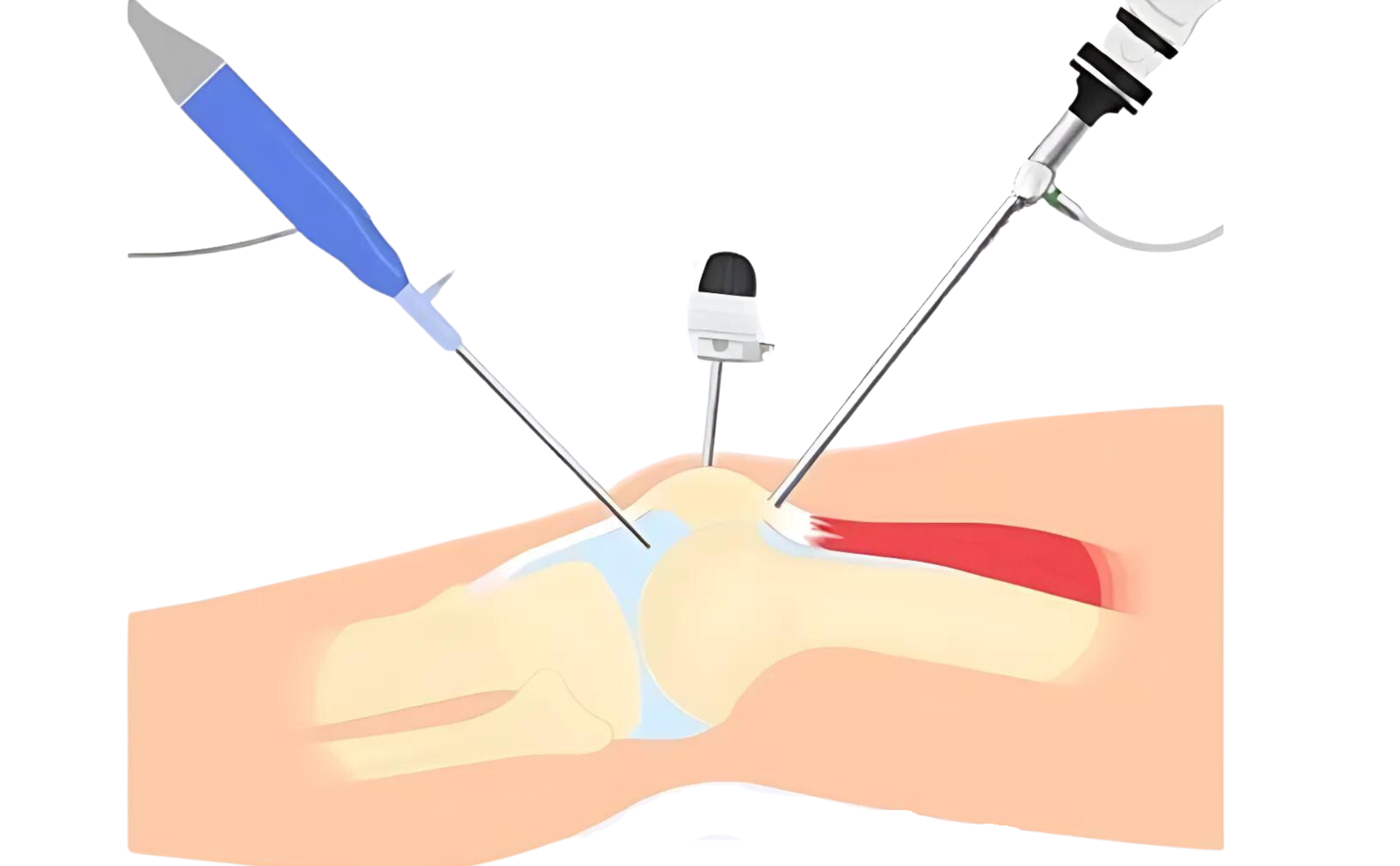 Shoulder Arthroscopy Surgery