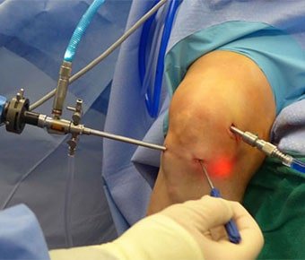 Knee Ligament Reconstruction Ahmedabad