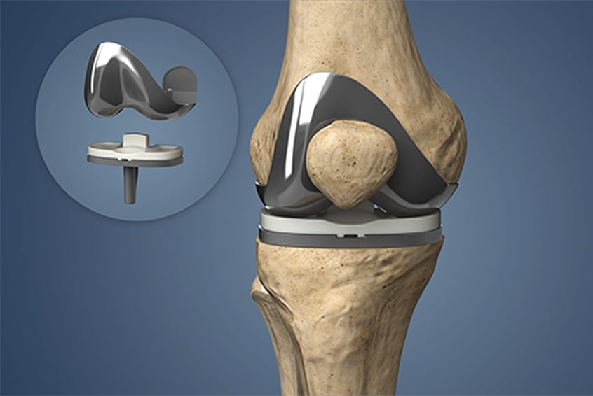 Robotic Knee Replacement Gujarat