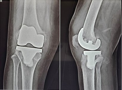 Knee Revision Surgery Ahmedabad